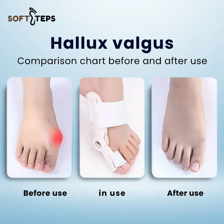 SoftSteps Bunion Toe Shaper (USA Imported 🇺🇸) BUY 1 Get 1 Free 🔥